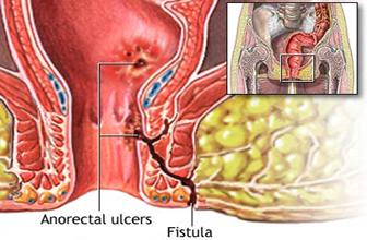 fistula