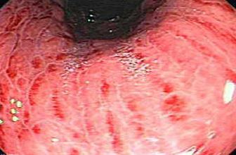 gastritis
