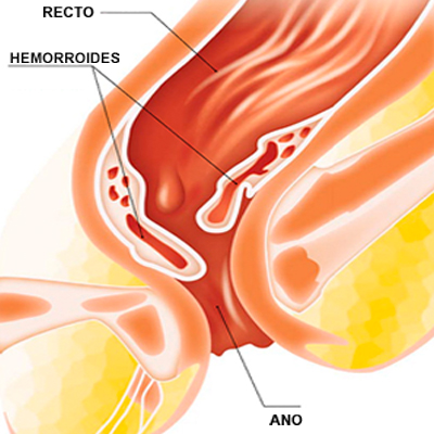 hemorroides